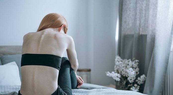 anorexia nervosa